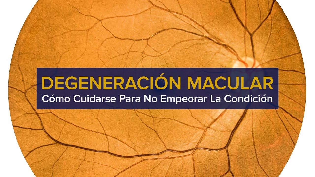 Thumbnail preview of Degeneración Macular - Cómo cuidarse para no empeorar la condición
