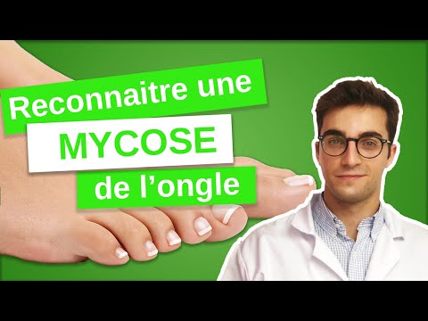 Savoir RECONNAÎTRE une MYCOSE de l'ongle - Onychomycose (1/3)