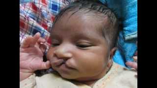 preview picture of video 'CLEFT LIP AND PALATE'