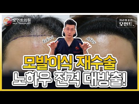 모발이식재수술 실패하지 않는 성공 노하우 ✨ l 김경복원장 l 모먼트의원(MOMENT)