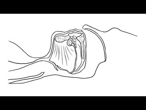 Im Schlaflabor: So wird Schlafapnoe diagnostiziert