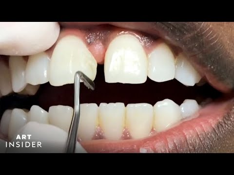 How Tooth Gaps Are Filled | Insider Art
