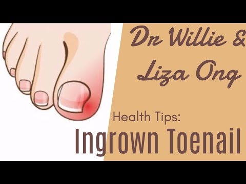 Anak na balat ng halamang-singaw kaysa sa pagalingin Kung paano gamutin ang bituka fungus