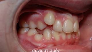 Crowding and midline deviation