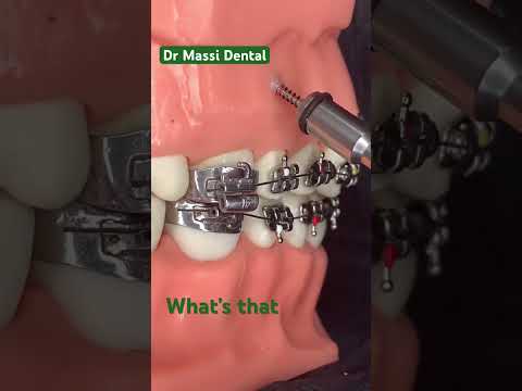 Dental Braces, Orthodontics,teeth alignment