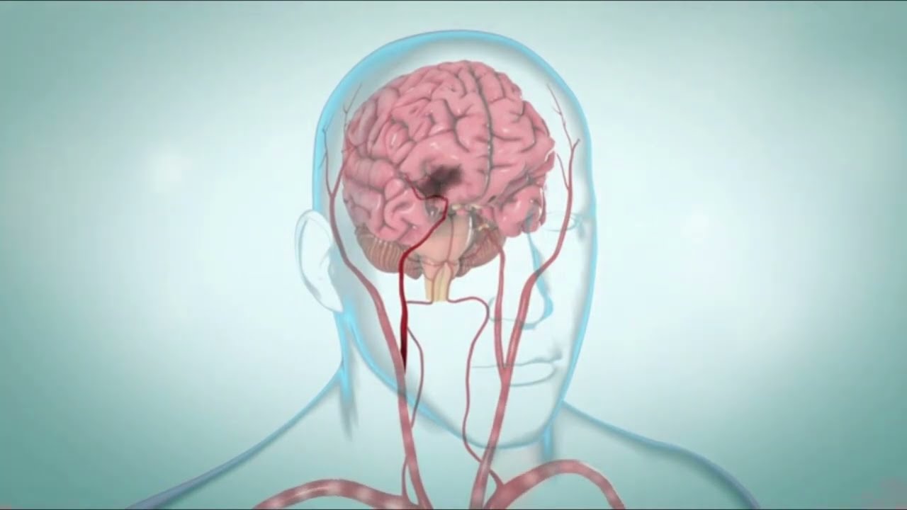 Ischemic Stroke: A Comprehensive Guide to Signs, types, and Treatment