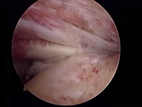 Surgical Rotator Cuff Repair Due To Impingement