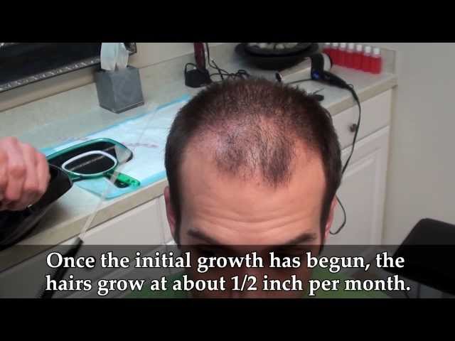 Ryan's Undetectable Scar: 1mo