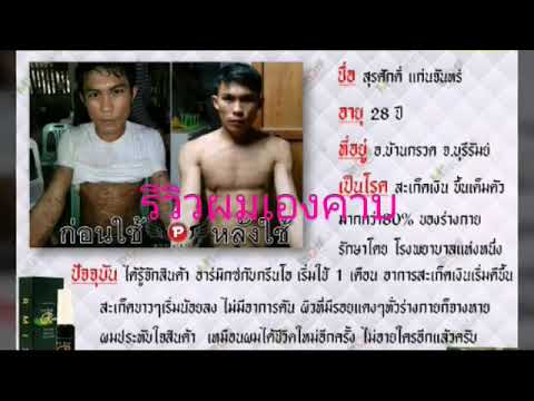 จุดสะเก็ดเงินในร่างกาย วัน neurodermatitis คัน