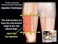 Vastus Lateralis Intramuscular Injection Everything You Need To Know Dr Nabil Ebraheim