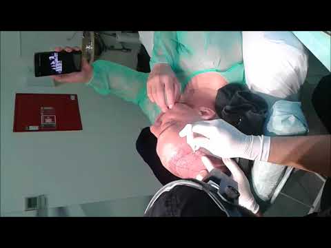 Transplante Capilar - Madeira Hair Clinic