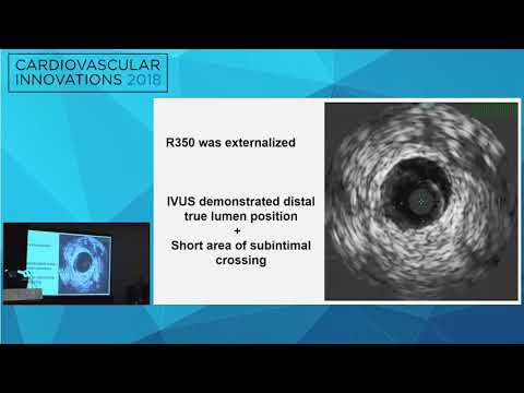 CVI2018 Session: Challenging Retrograde CTO Crossing - Iosif Xenogiannis, MD