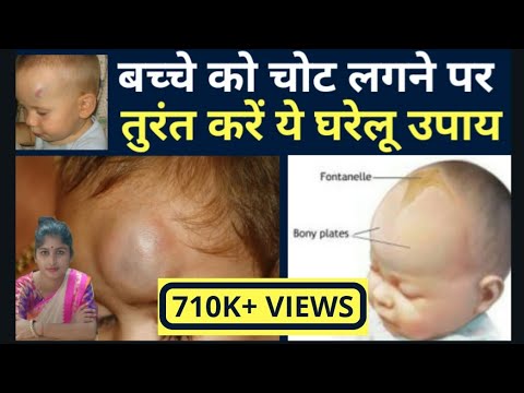 बच्चे को चोट लगने पर तुरंत ये करें घरेलू उपाय ,what to do if baby gets hurt on head.