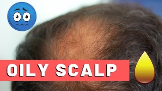 Oily Scalp Treatment For Hair Loss: The Best Way