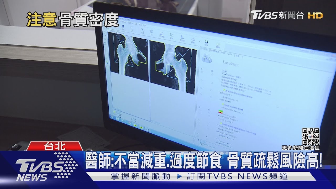 有片／30歲後骨密度開始走下坡　出現這兩件事骨鬆機率高！