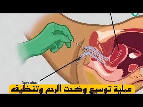 عملية توسيع وكحت الرحم | كل ما تحتاجين معرفته عن الكحت بالتفصيل .
