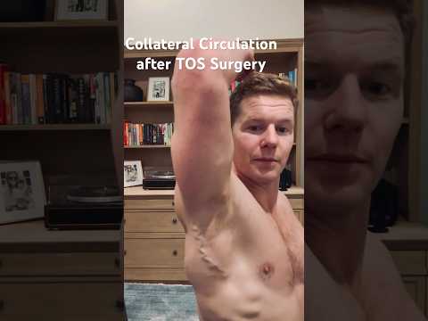 Collateral Blood Flow after my vTOS surgery! #tos #thoracicoutletsyndrome #humanbody