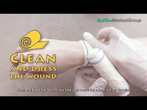 First Aid: How to Treat Burns