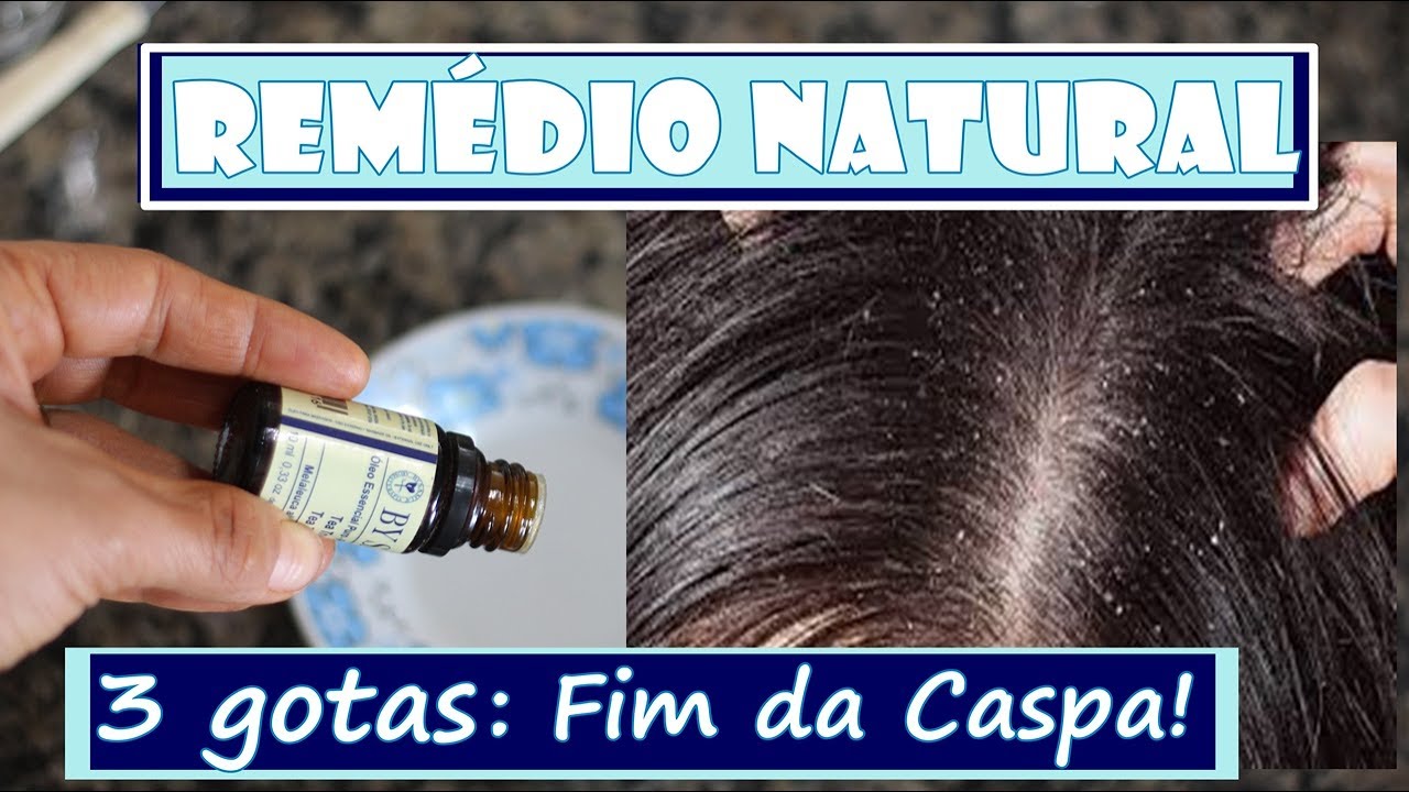 ELIMINANDO A CASPA COM ESSE SURPREENDENTE REMÉDIO NATURAL - Fran Adorno