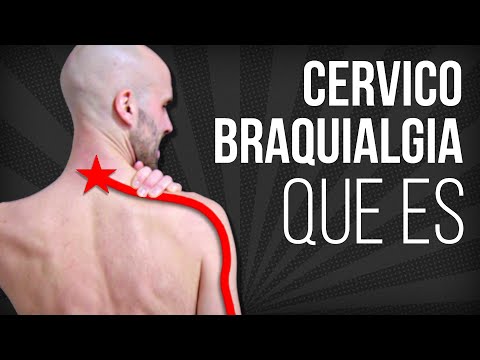 ⚡CERVICOBRAQUIALGIA, que es, por que se produce, y cual es su TRATAMIENTO
