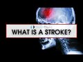 What Is A Stroke Causes Different Types And How To Recognise Them