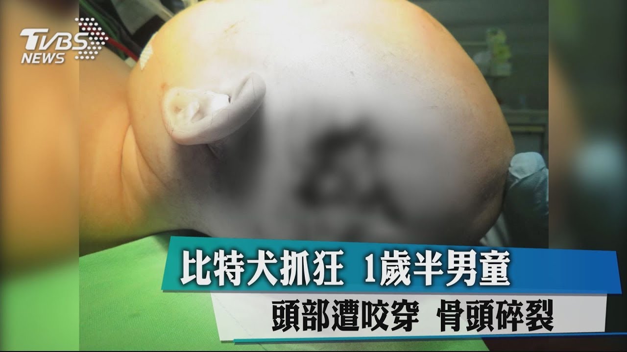 比特犬攻擊1歲半男童 頭部遭咬穿骨頭碎裂
