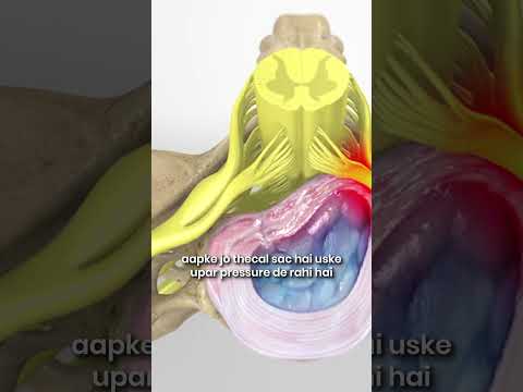 What Does a Lumbar Slip Disc Look Like on an MRI? | Dr. Ajay Kothari
