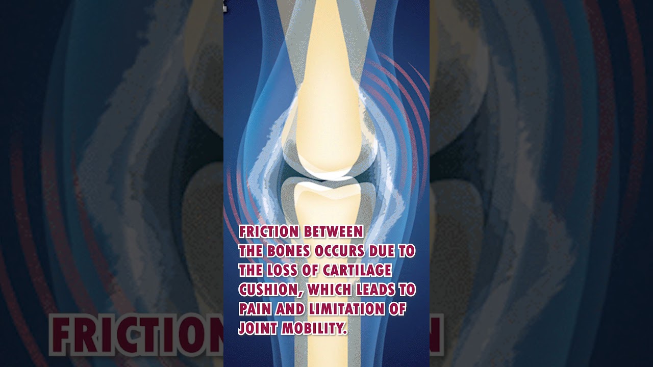 Primary Osteoarthritis | Stem Cell Therapy for Osteoarthritis in India | Exosome Therapy | Stem Cell