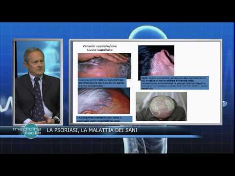 Omeopatia a dermatite atopic ad adulti Trattamento di clinica di eziologia di eczema