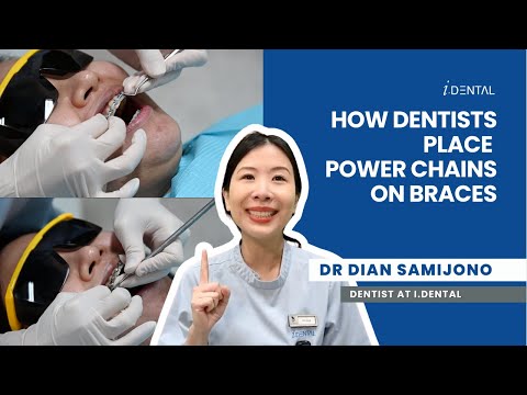 How Do Dentist Put Power Chains On Your Braces?
