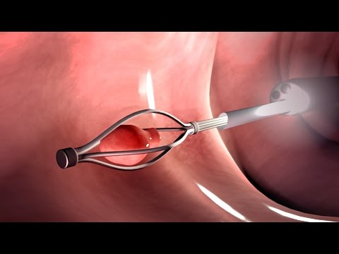Miniatura do vídeo: Como é realizada a colonoscopia