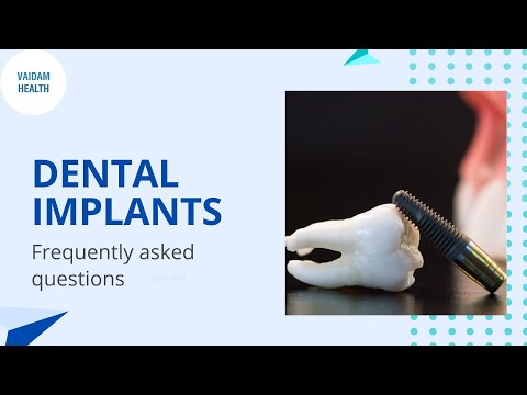Dental implants- Frequently Asked Questions