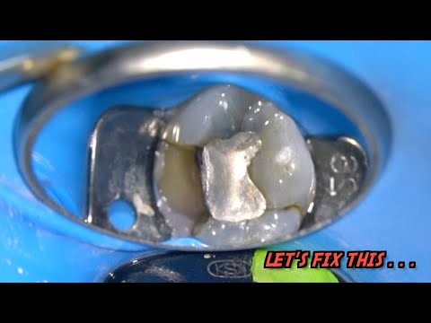 Molar Root Canal Treatment | Tooth Decay Beneath Silver Filling