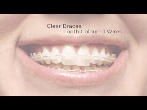 Fast Tooth Straightening -  Six Month Smiles
