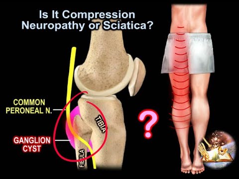 Is It Compression Neuropathy or Sciatica - Everything You Need To Know - Dr. Nabil Ebraheim