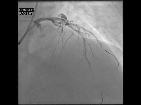 LAD – PCI 1