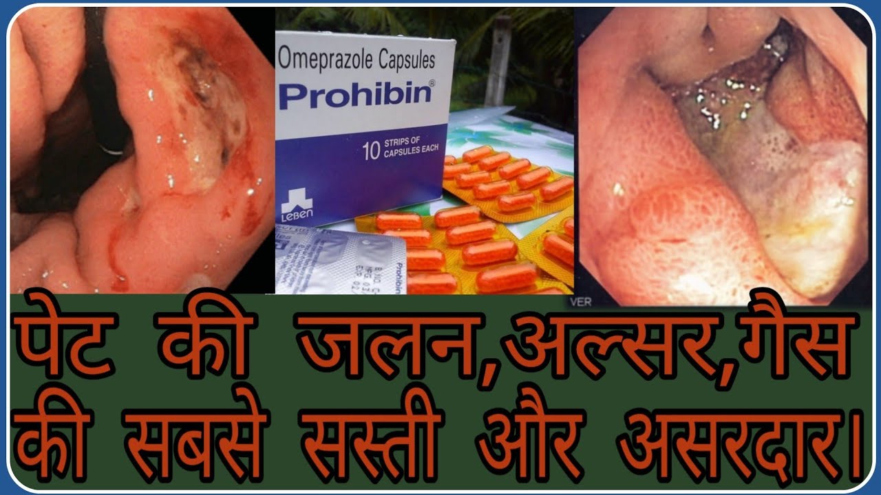 प्रोहिबिन कैप्सूल(Prohibin Capsul) मात्रा 10 रुपये खर्च और पेट की गैस,जलन,खट्टी डकार,अपच,से छुटकारा।