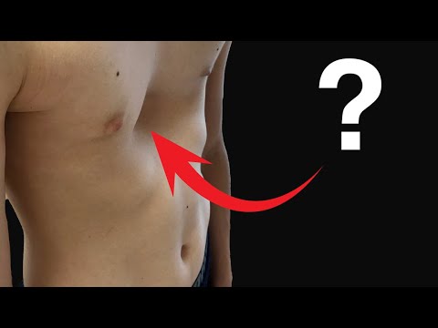 The TRUTH About Pectus Excavatum