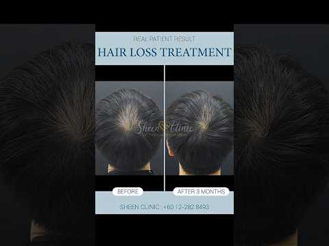 PRP Hair Loss Treatment | Regrow Thicker & Stronger Hair