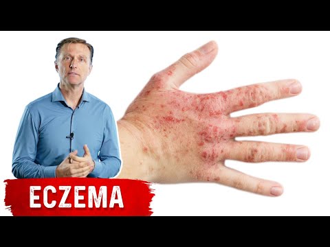 Which Vitamin Deficiency Causes Chapped Cracked Lips – Dr Berg