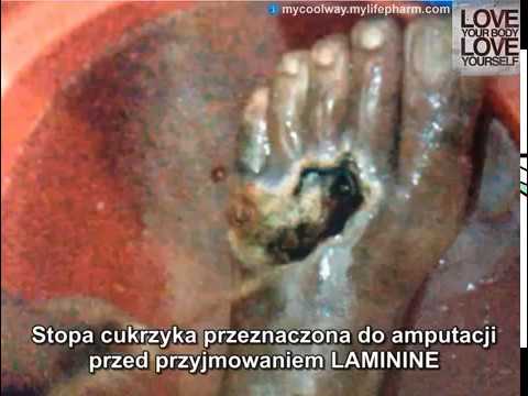 Koślawego goleniach dzieci zdjęcia Build-up na dużym palcu, jak traktować ludzi środkami