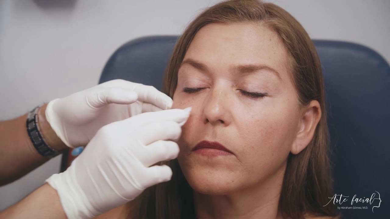 Rellenos de Ácido Hialurónico para el tratamiento de bolsas y ojeras en los ojos.