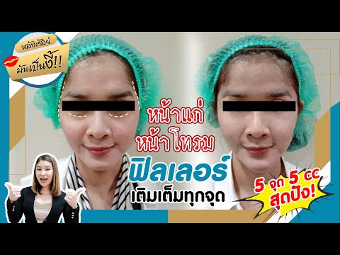 เมโสแฟต ยี่ห้อไหนดี