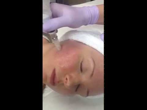 See Rejuvapen™ Micro-needling Device in action, used for anti-aging and core skin care