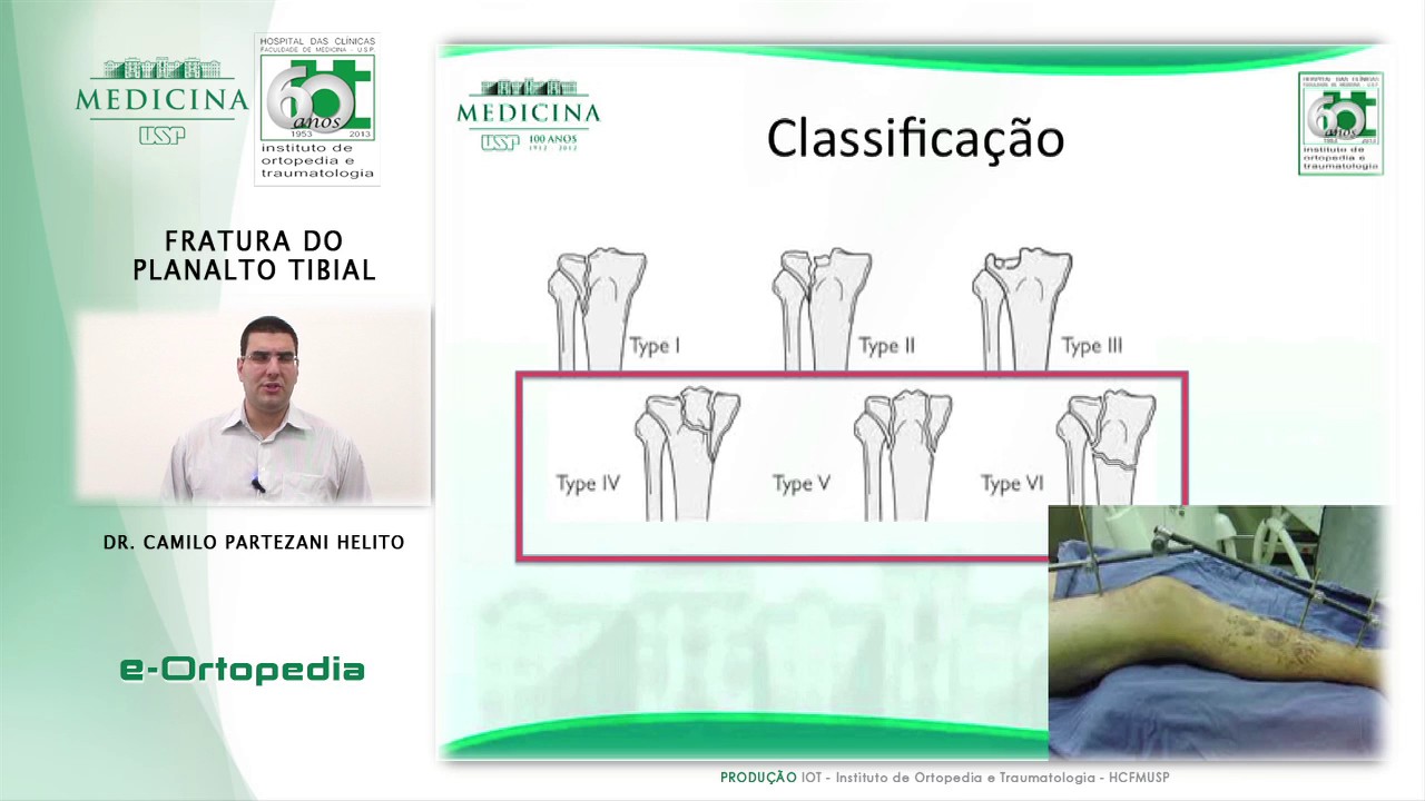 Fratura do Planalto Tibial - Dr. Camilo Partezani Helito