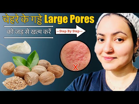 In 7 Days💕 चेहरे के पुराने गड्ढे, DEEP ACNE SCARS, LARGE PORES को जड़ से ठीक करें इस Remedy से