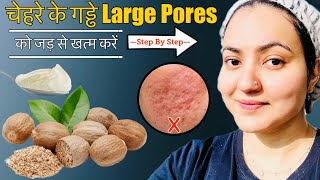 In 7 Days💕 चेहरे के पुराने गड्ढे, DEEP ACNE SCARS, LARGE PORES को जड़ से ठीक करें इस Remedy से