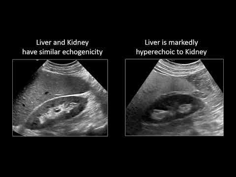 image-What does fatty liver on ultrasound mean?