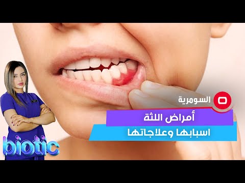 شاهد بالفيديو.. ما هي أهم أمراض اللثة وما هي اسبابها وعلاجاتها؟