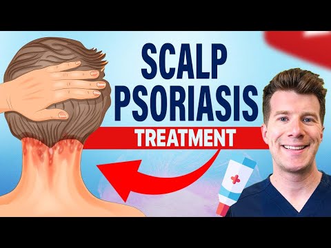 Doctor explains FOUR TREATMENTS for SCALP PSORIASIS